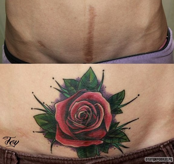 Фотография татуировки под названием «Роза на шраме»